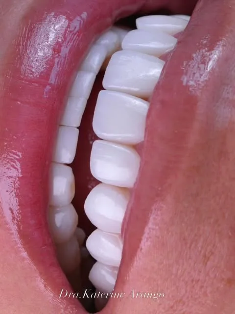 Diseño de sonrisa — nuestro caso